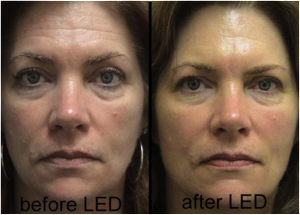 LED_Treatment Before and After